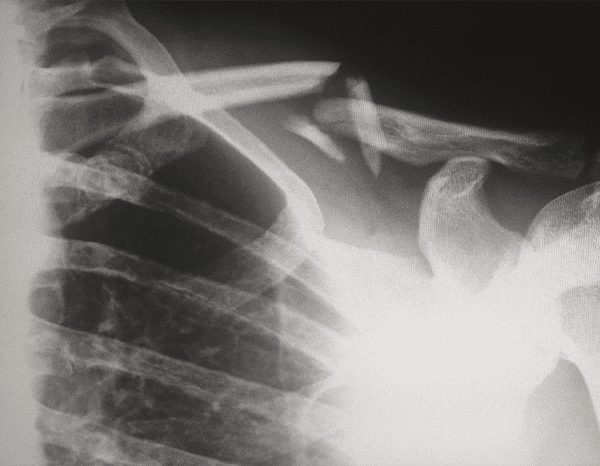 X-ray of broken bones