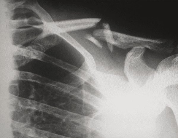 X-ray of broken bones X-ray of broken bones