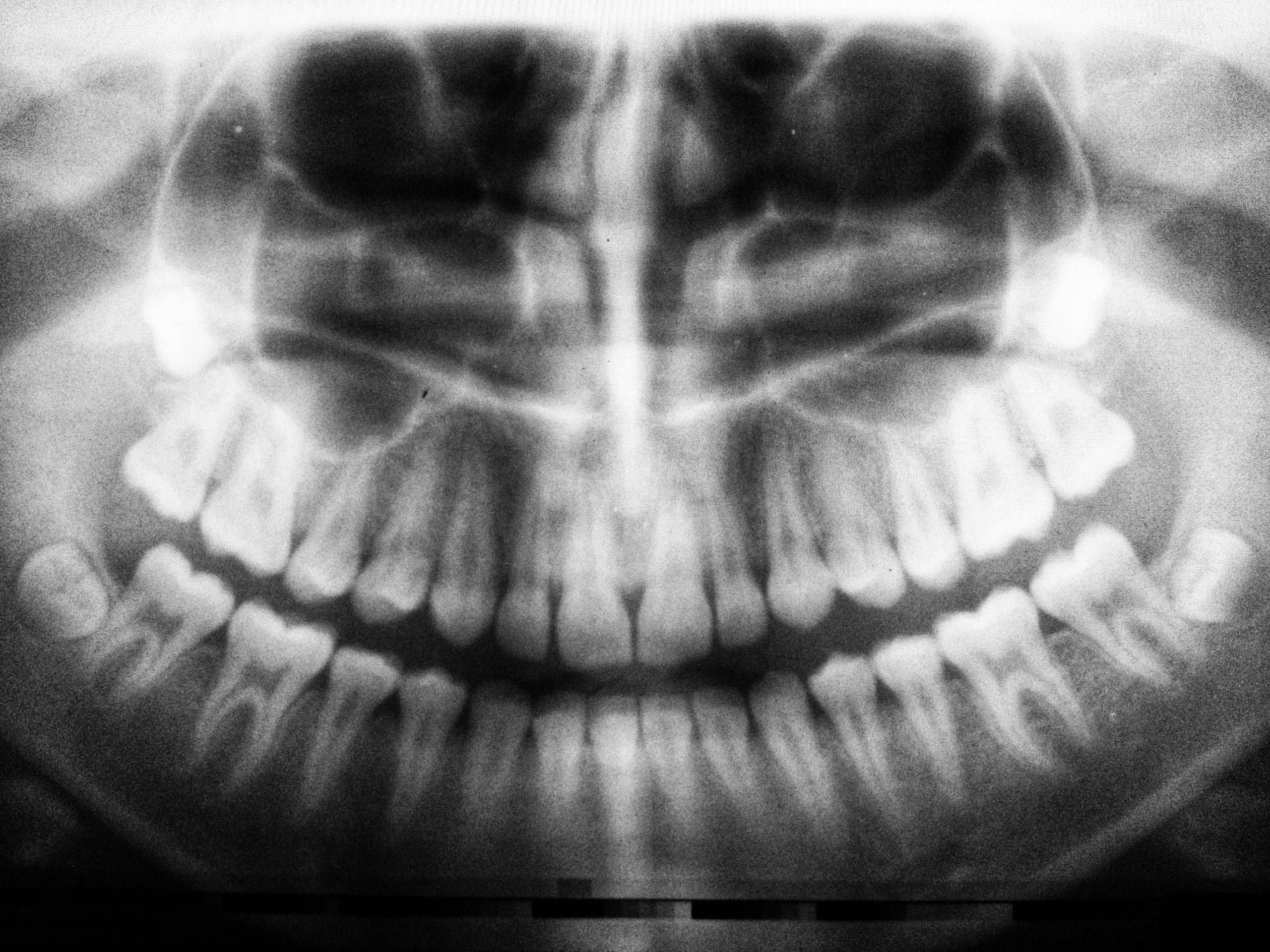 x-ray of the teeth x-ray of the teeth